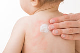 A Parent’s Guide to Eczema in Children: Understanding, Managing, and Treating Eczema