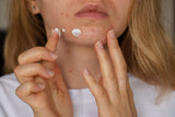 HOCl vs Benzoyl Peroxide: Which Hero Will Save Your Skin?