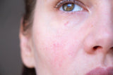 The Inside Scoop on Rosacea