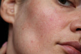 The Inside Scoop on Sensitive Skin